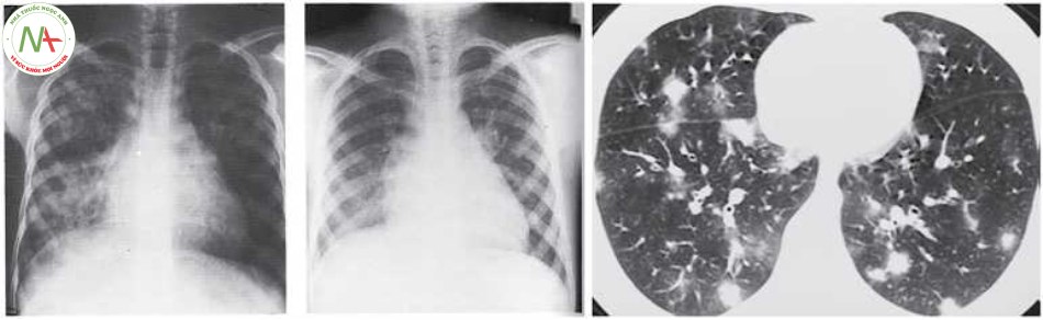 Hình 5 Tổn thương dạng thâm nhiễm Loeffler trên X-quang ngực và mờ dạng nốt, dấu hiệu quầng sáng trên CT ngực do Schistosoma phổi