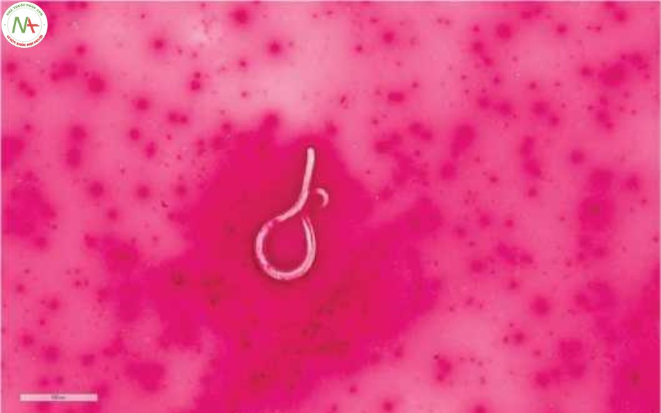 Hình 6 Ấu trùng Strongyloides trong dịch rửa phế quản - phế nang