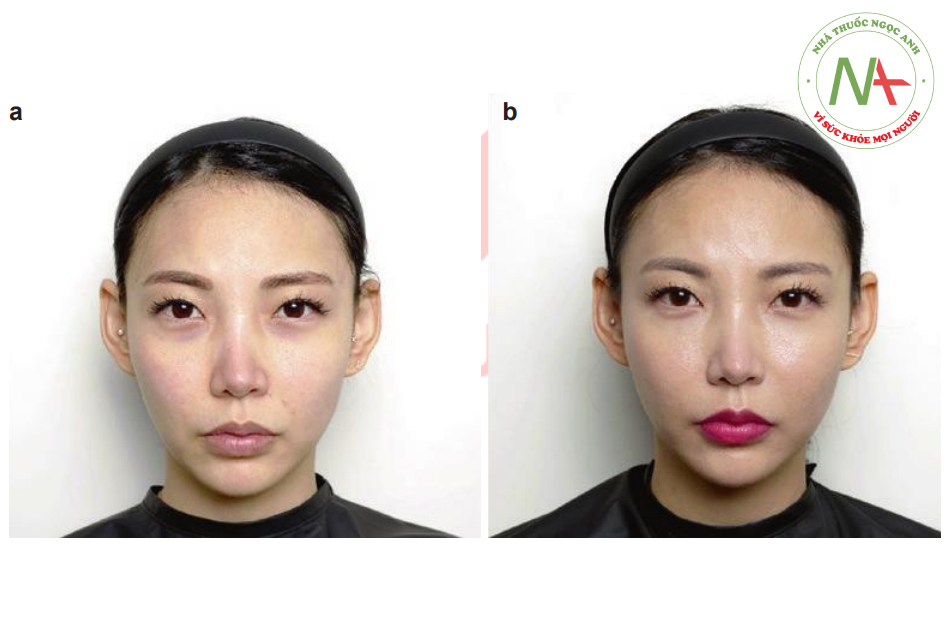 Hình. 7.14 Một bệnh nhân 35 tuổi tiên làm đầy vùng mặt giữa- (a)Góc nhìn thẳng trước tiêm, (b) Góc thẳng 2 tuần sau tiêm, (c) Góc ¾ mặt trước tiêm (d) Góc ¾ mặt sau tiêm 2 tuần (e) Góc nghiêng trước tiêm, và (f) Góc nghiêng sau tiêm 2 tuần