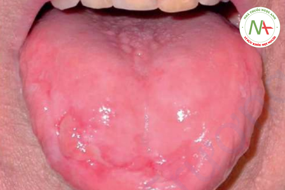 HÌNH 11.15 Lichen phẳng ở miệng – loét trên lưỡi cần sinh thiết để loại trừ bệnh ác tính.