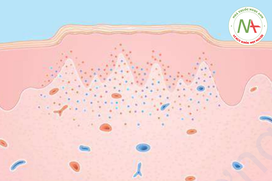 HÌNH 11.17 Lichen phẳng. Biểu bì – tăng sừng; thoái hóa lớp tế bào đáy; kiểu hình "răng cưa" của gờ rete. Lớp bì – thâm nhiễm tế bào lympho dày đặc, dạng dải ở lớp bì nông.