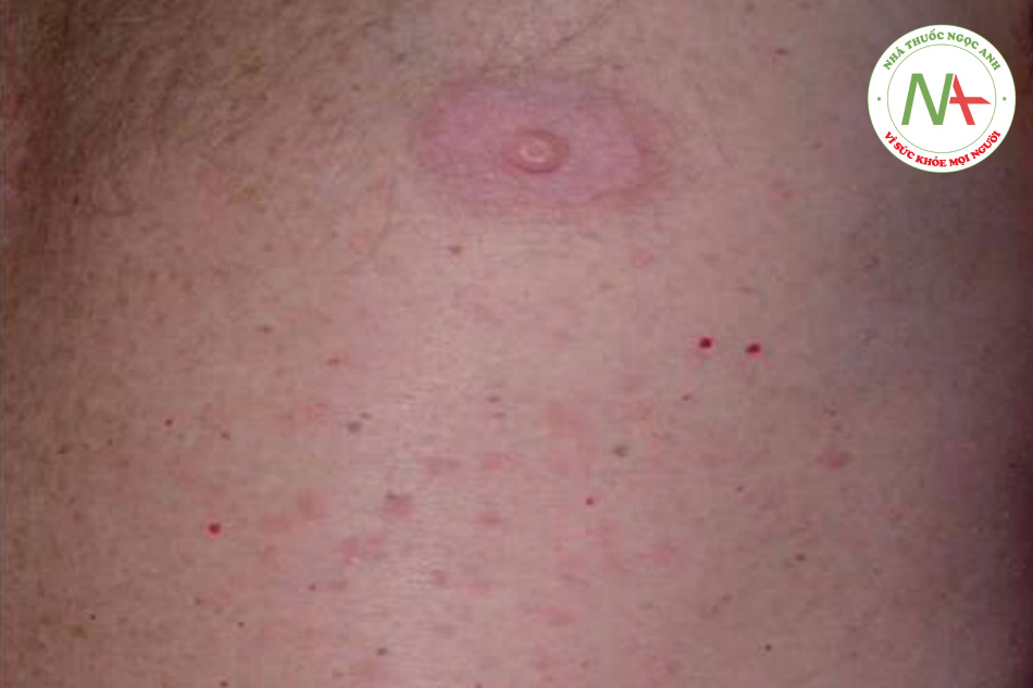 HÌNH 11.32 Transient acantholytic dermatosis (bệnh Grover) – các sẩn màu nâu đỏ có mài với vị trí đặc trưng ở thân mình.