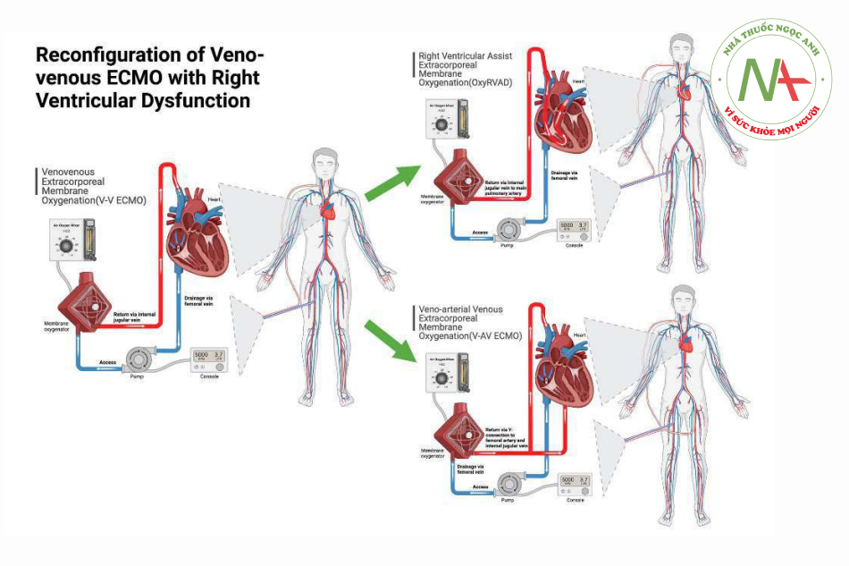 Hình 4 Cấu hình V-V ECMO. Sơ đồ minh họa cấu hình lại của V-V ECMO thông thường thành ECMO hỗ trợ tâm thất phải (OxyRVAD) hoặc ECMO tĩnh mạch-động mạch (V-AV ECMO)
