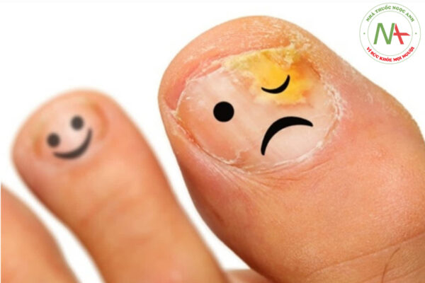 Bệnh nấm móng tay-móng chân Triệu chứng, nguyên nhân và điều trị