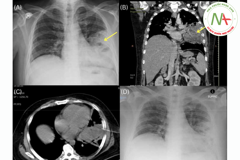 Hình 1. (A) X-quang ngực ban đầu cho thấy hình ảnh đông đặc cạnh bờ tim trái, gợi ý viêm phổi hoặc khối u (mũi tên). (B) Chụp cắt lớp vi tính lồng ngực có tiêm thuốc cản quang, mặt cắt coronal (mặt phẳng trán), hình ảnh đông đặc cạnh tim trái với các vùng chứa khí, gợi ý áp xe phổi hay khối u (mũi tên). (C) Sinh thiết xuyên thành ngực dưới hướng dẫn của CT. (D) Chụp X-quang ngực sau 1 tháng cho thấy đám đông đặc cải thiện.