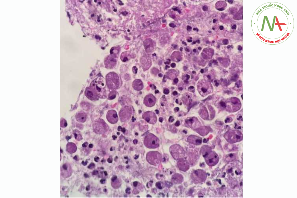 Hình 2. Sinh thiết xuyên thành ngực tìm thấy các thể tư dưỡng của E. Histolytica, bạch cầu đa nhân trung tính (PMNs: Polymorphonuclear neutrophils), tế bào lympho và mô liên kết. Kết quả mô bệnh học phù hợp với chẩn đoán bệnh phổi do amip.