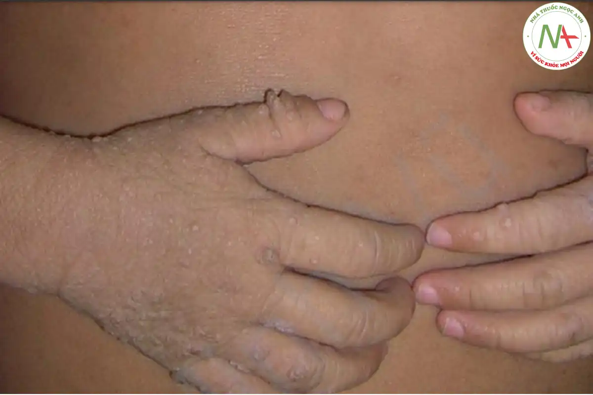 Giảm sắc tố sau viêm – các dát giảm sắc tố trên ngực ở trẻ bị viêm da cơ địa dị ứng