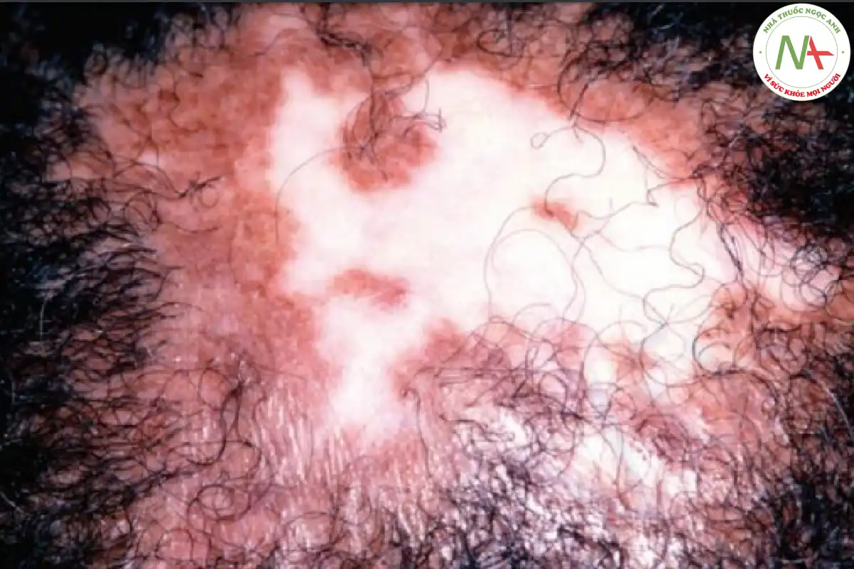 Giảm sắc tố sau viêm – các dát trắng trên da đầu thứ phát do bệnh lupus ban đỏ dạng đĩa