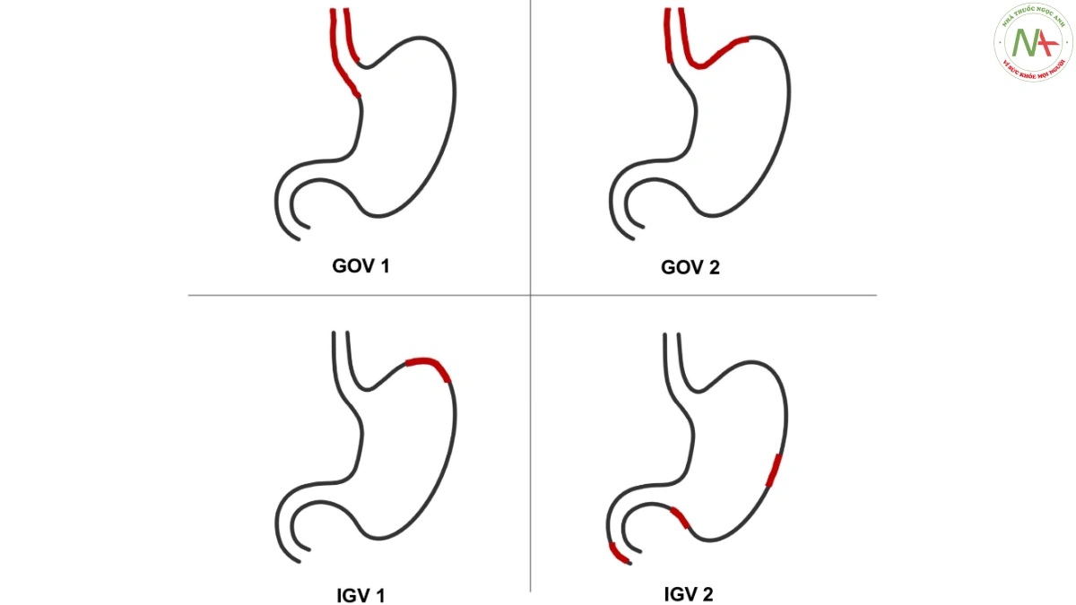 Hình 2. Hình phân loại giãn tĩnh mạch dạ dày theo phân loại Sarin (GOV: giãn tinh mạch thực quản dạ dày; IGV: giãn tĩnh mạch dạ dày đơn thuần)