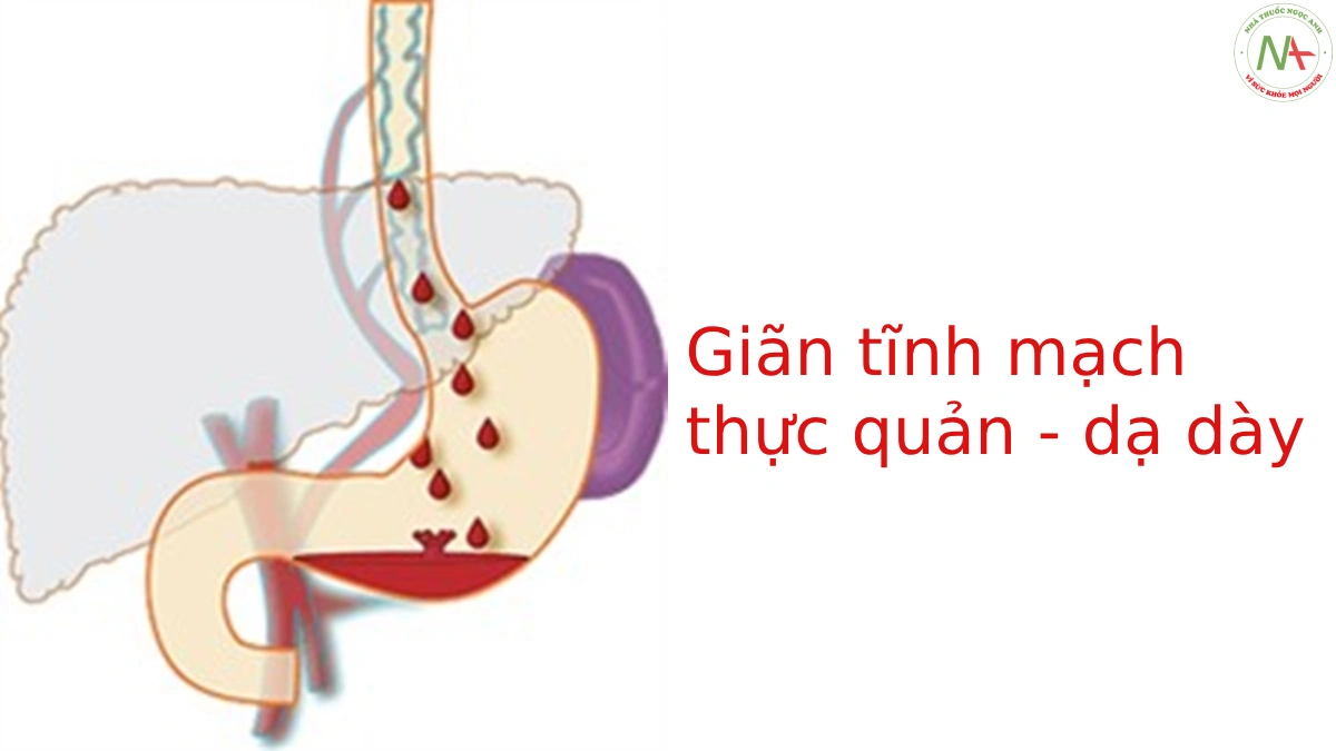 giãn tĩnh mạch thực quản - dạ dày