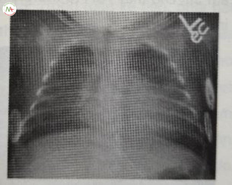 Hình 24.13 Chụp X-quang lúc 2 tháng tuổi vẫn cho thấy bệnh phổi còn lại.