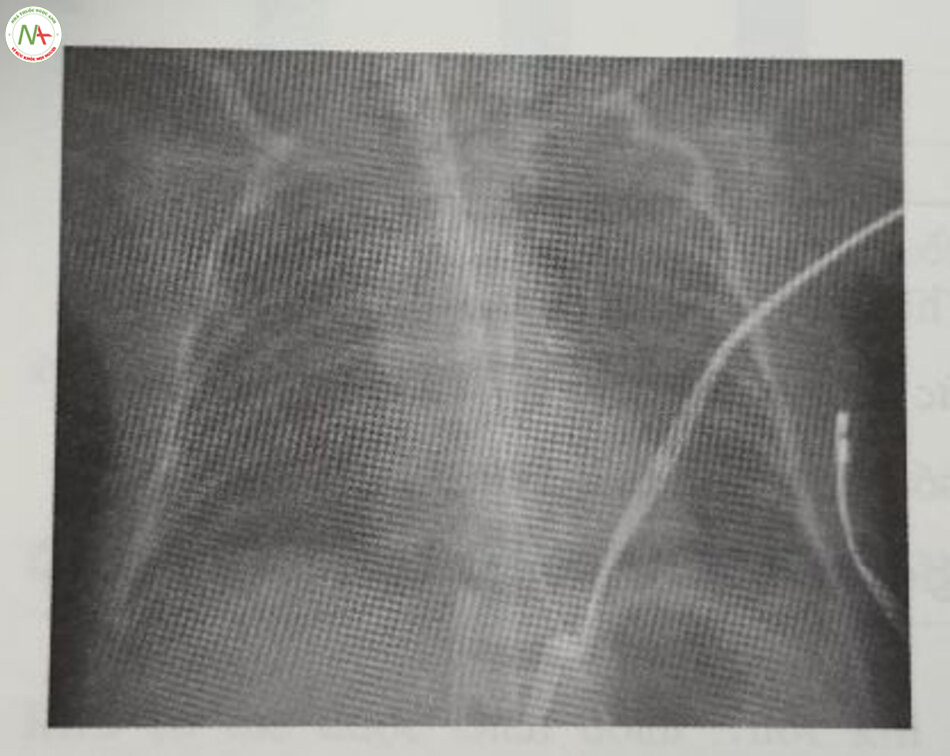Hình 24.5 X-quang ngực cho thấy RDS nhẹ.