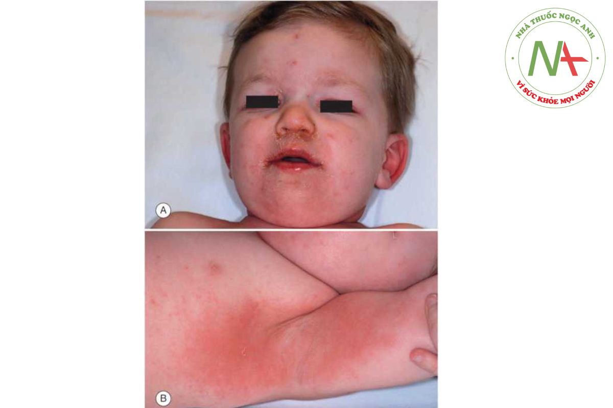 HÌNH 14.19 A. Hội chứng bỏng da do tụ cầu -mũi là ổ nhiễm trùng. B. Ban đỏ do độc tố từ Staphylococcal aureus nổi bật ở nếp gấp da.