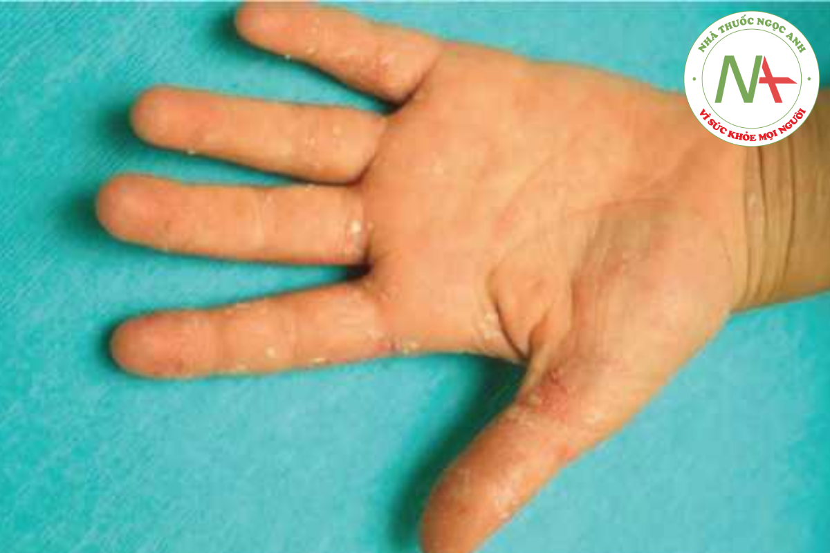 HÌNH 14.22 Hội chứng Kawasaki - bong vảy sau ban đỏ và phù ở tay, một dấu hiệu điển hình.