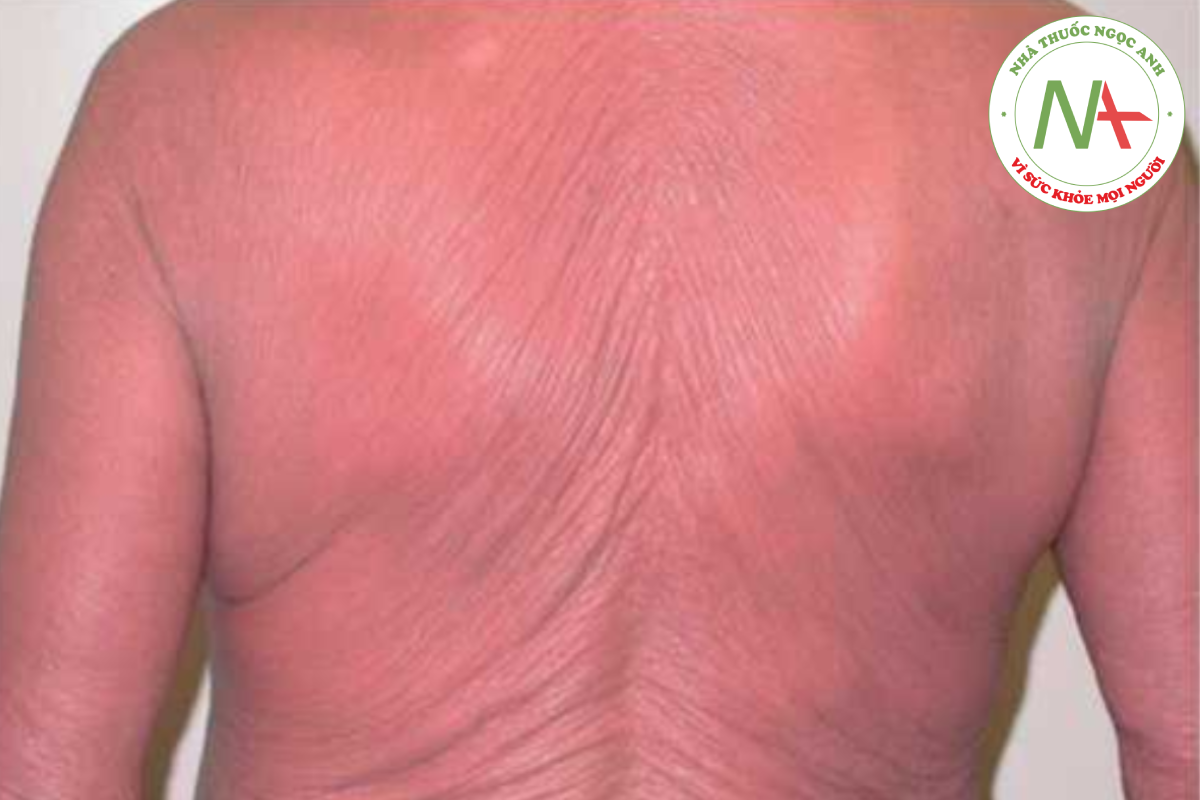 HÌNH 14.23 Đỏ da toàn thân (Erythroderma) - ban đỏ lan toả mặc dù đã điều trị tích cực nhưng vẫn có tính chất tự phát.