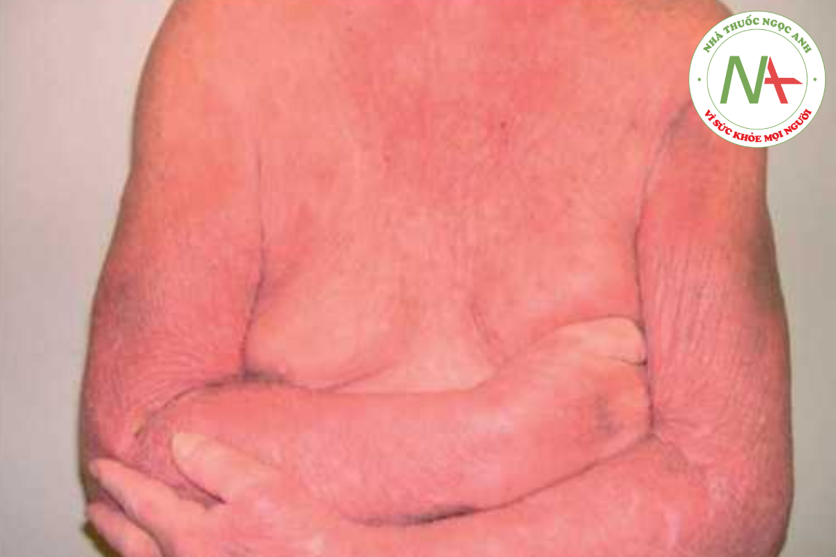 HÌNH 14.24 Hội chứng Sézary -đỏ da toàn thân tróc vảy kèm theo hạch to sờ thấy được.