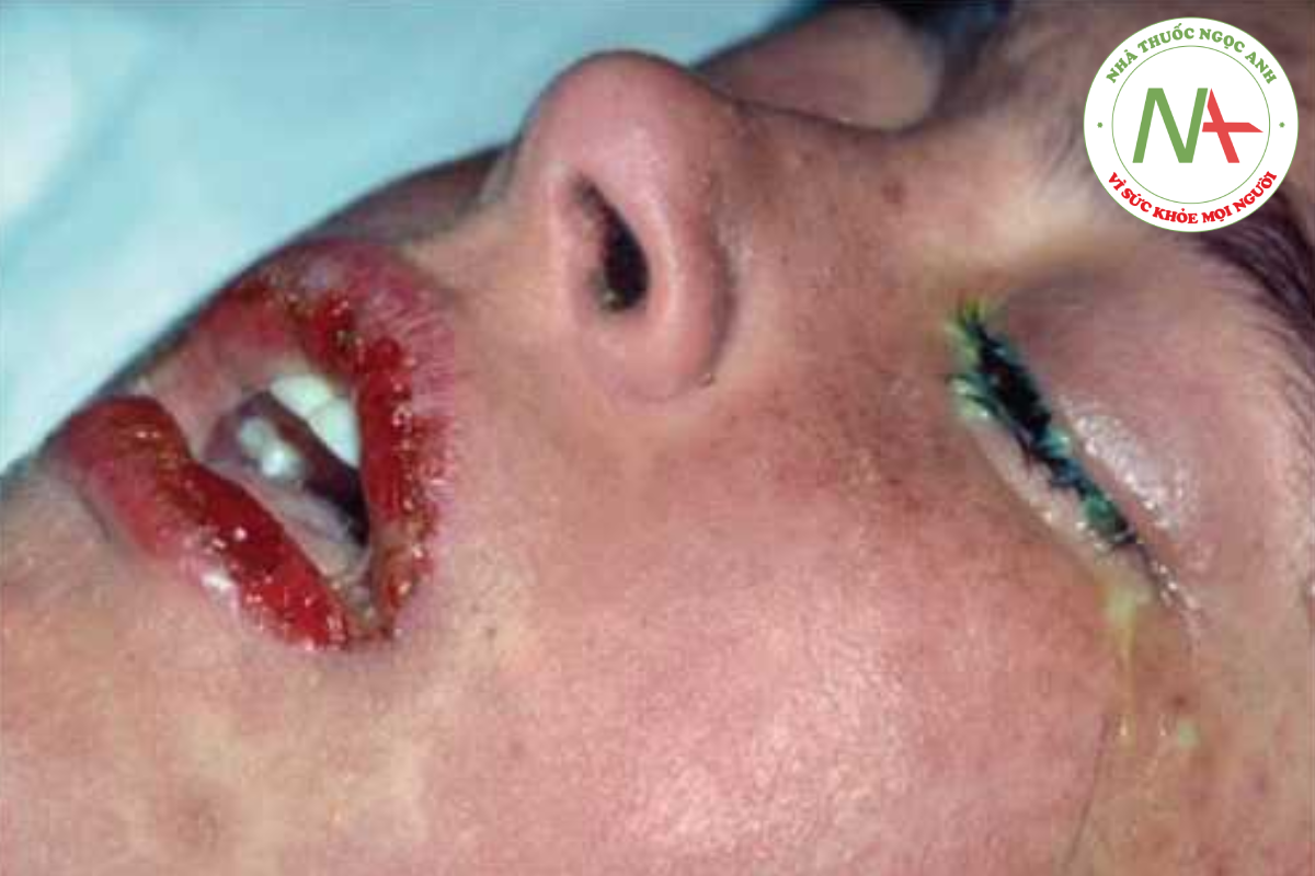 HÌNH 14.5 Hội chứng Steven-Johnson -ban đỏ và tổn thương hai bề mặt niêm mạc - môi và kết mạc xuất huyết.