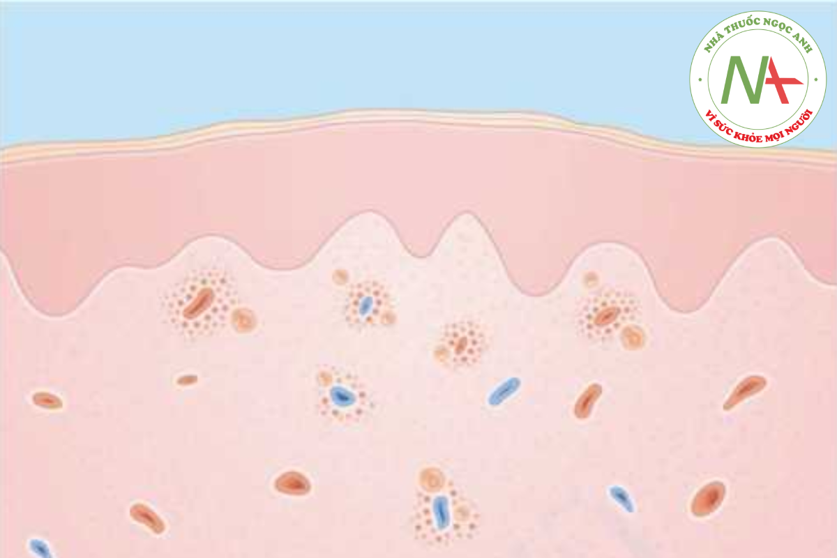 HÌNH 14.8 Biểu bì - bình thường. Lớp bì - thâm nhiễm tế bào viêm nông và sâu quanh mạch máu gồm bạch cầu ái toan.