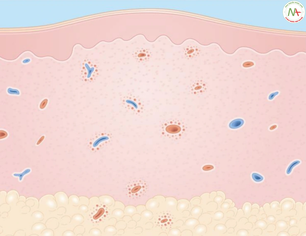 HÌNH 11: Viêm mô tế bào. Biểu bì - bình thường. Lớp bì – viêm lan tỏa qua lớp bì, kéo dài vào lớp mỡ dưới da