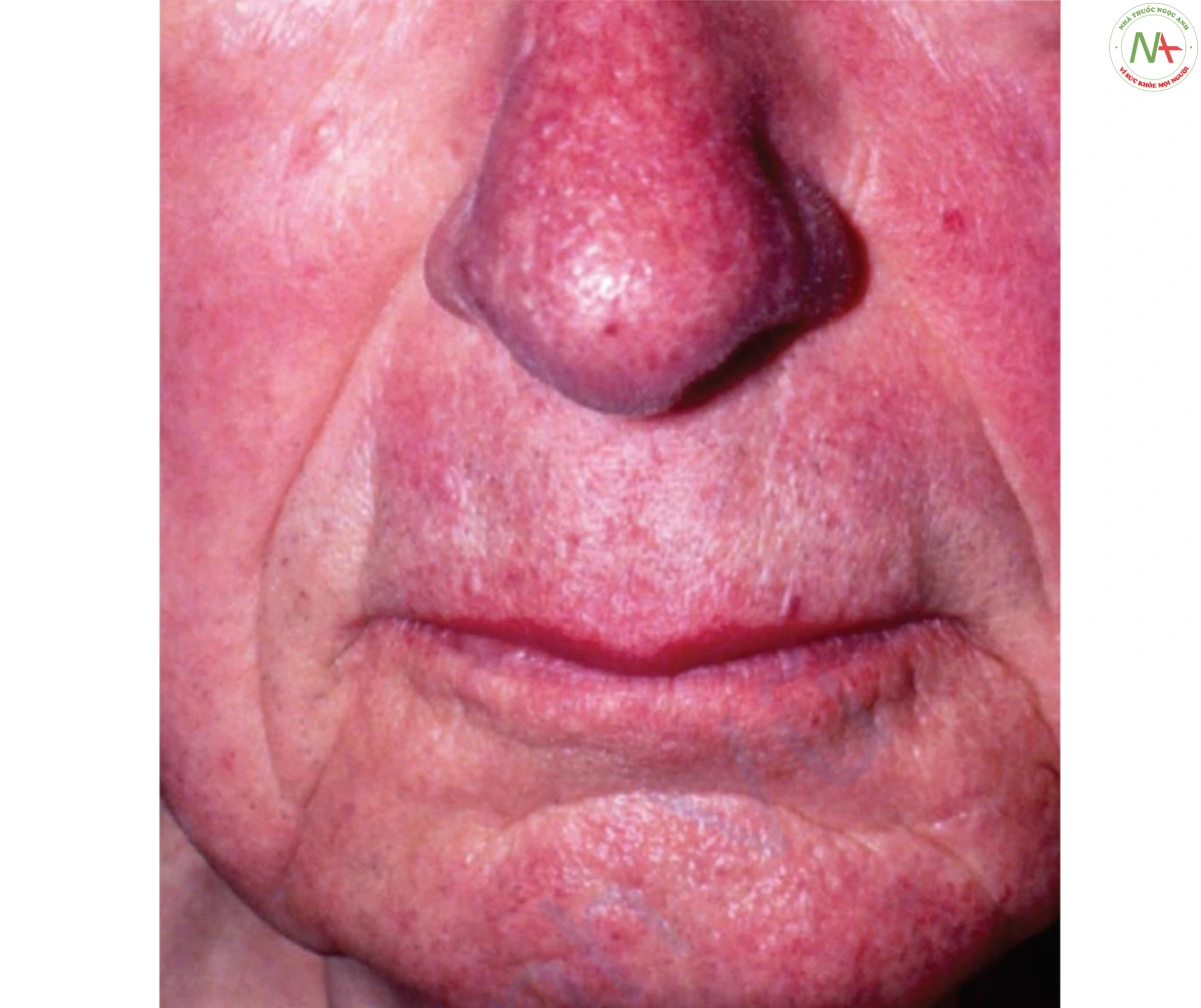 HÌNH 15 Carcinoid – ban đỏ dai dẳng và đỏ bừng mặt ở bệnh nhân di căn gan