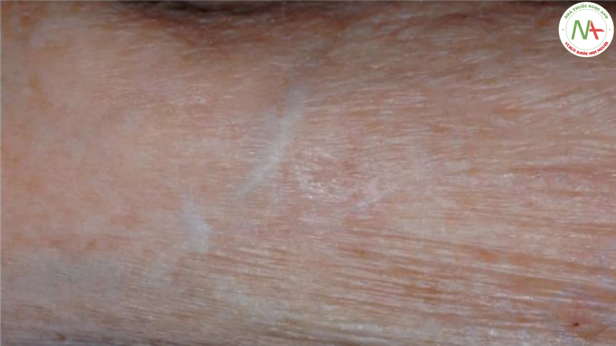 HÌNH 17.3 Sẹo giả hình sao trên cẳng tay – sẹo trắng mỏng do vết rách da lành lại, thường thấy với ban xuất huyết ánh sáng