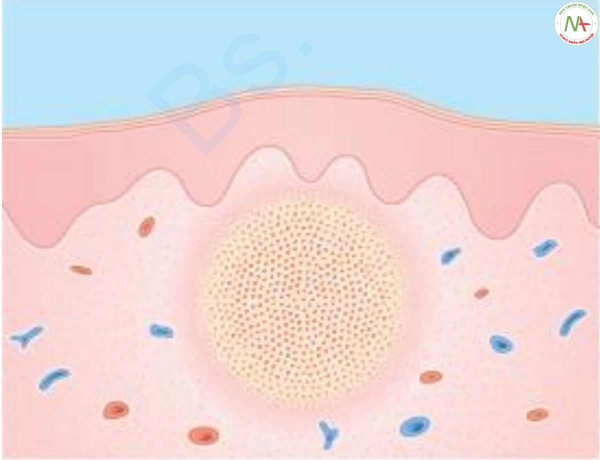 HÌNH 4: Áp xe. Biểu bì - bình thường. Lớp bì – tập hợp dày đặc của các tế bào viêm cấp tính thay thế lớp bì hoại tử