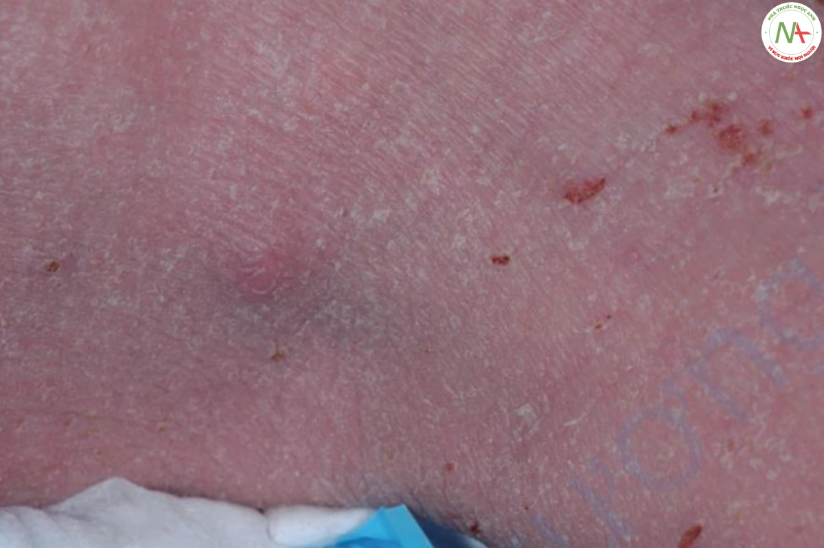 HÌNH 5 Áp xe. Lưu ý nốt ở hố khoeo trên da bị viêm của bệnh nhân viêm da cơ địa dị ứng