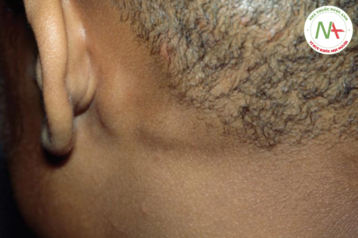 HÌNH 20.16 Nấm da đầu - sưng hạch kết hợp với các mảng rụng tóc là dấu hiệu điển hình.