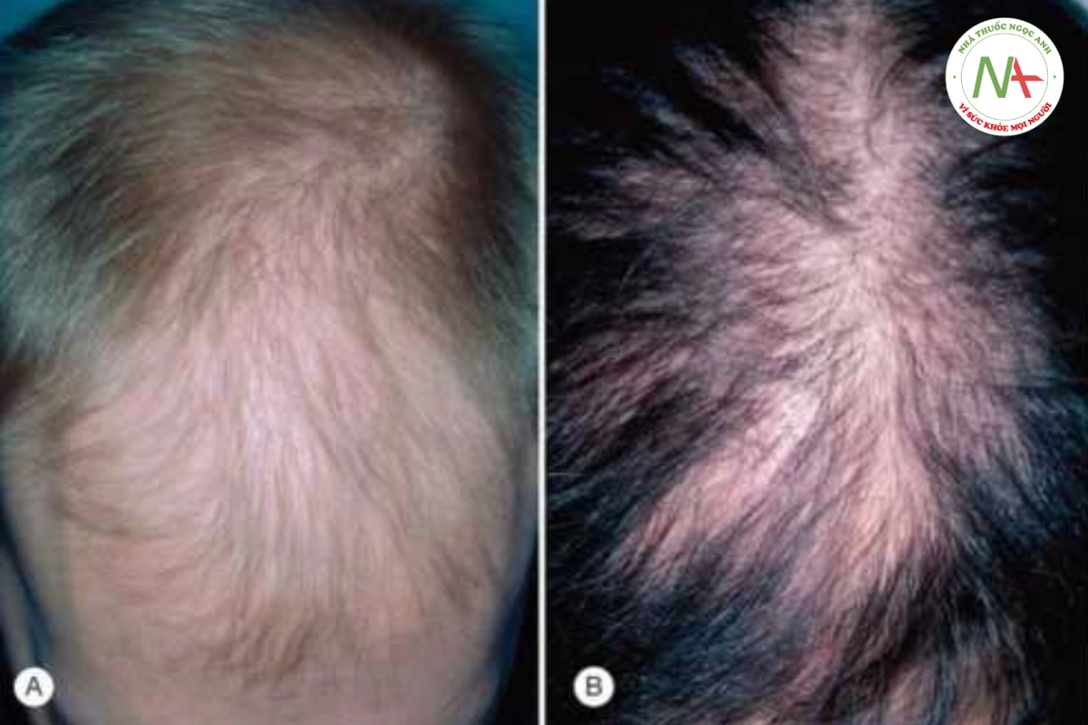 4 phương pháp cải thiện rụng tóc ở nam giới - VnExpress Sức khỏe