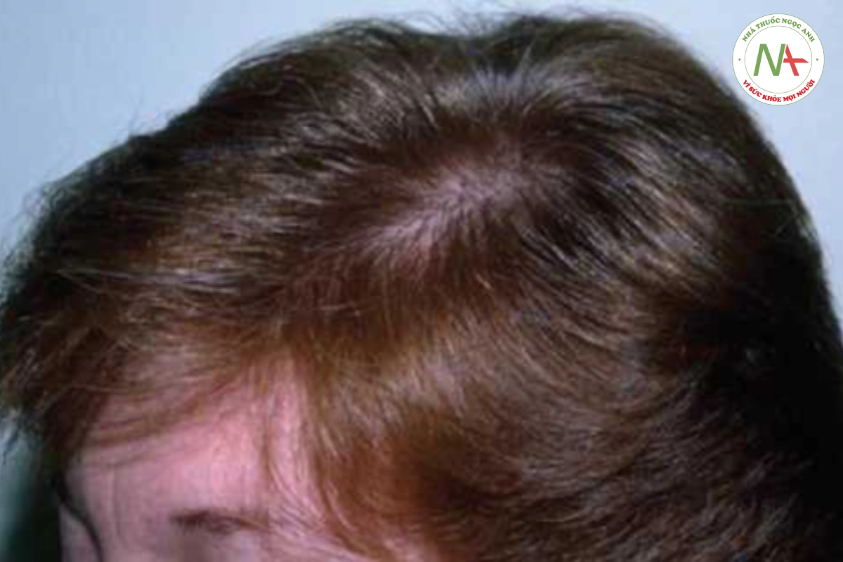 HÌNH 20.13 Rụng tóc telogen- tóc mỏng không dễ nhận thấy đối với người quan sát bình thường.