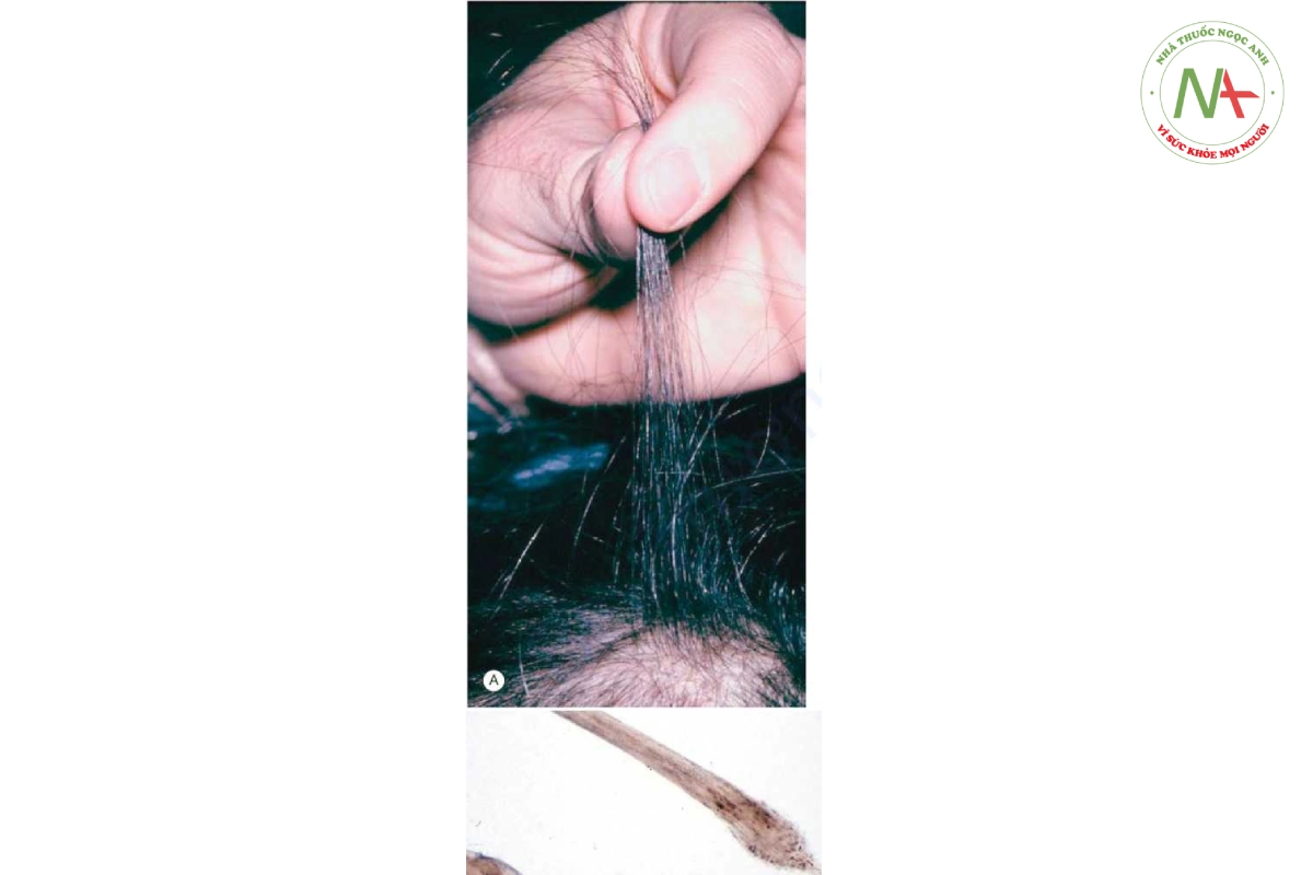 HÌNH 20.14 A. Test kéo tóc nhẹ. B. Kiểm tra bằng kính hiển vi cho thấy tóc telogen hoặc club.