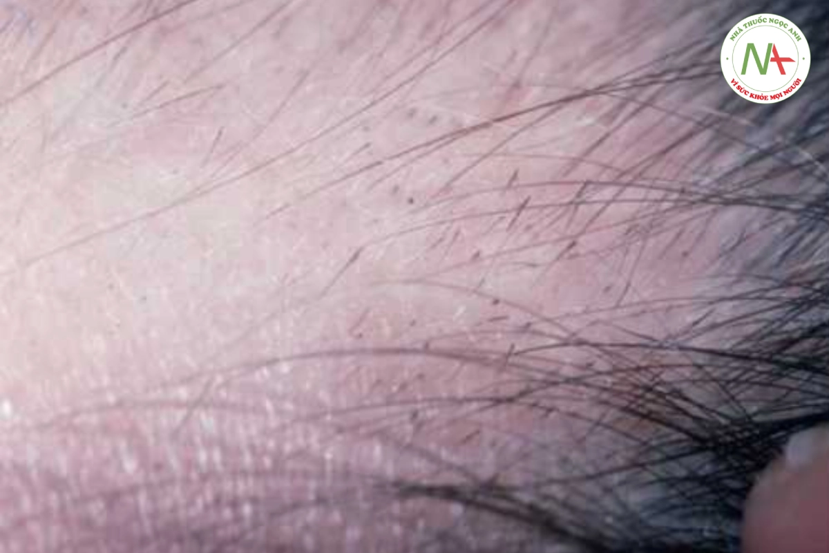 HÌNH 20.2 Rụng tóc từng mảng -các sợi tóc có dấu chấm than ở vùng rìa của rụng tóc.