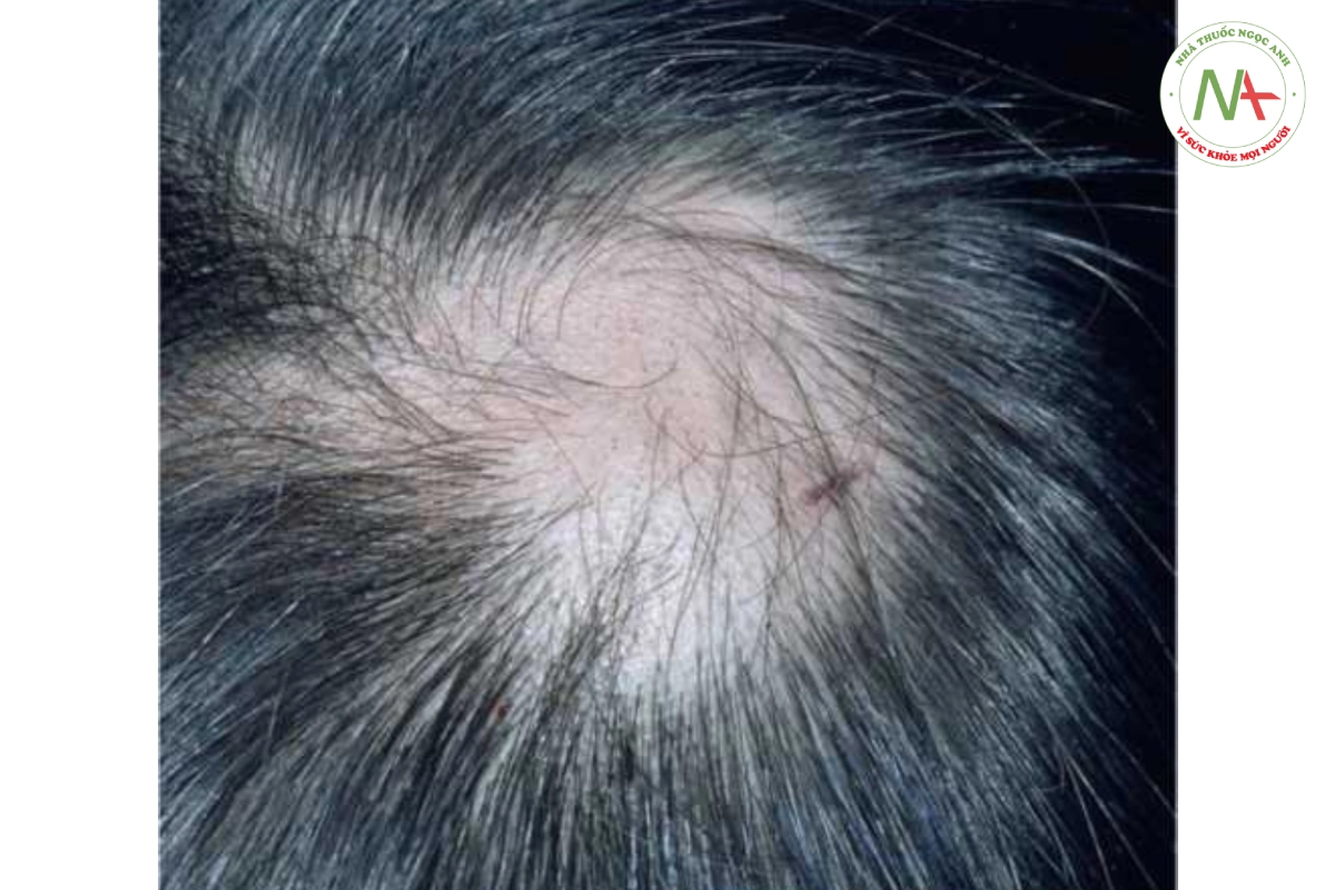 HÌNH 20.5 Tật nhổ tóc (trichotillomania). Lưu ý những sợi tóc có độ dài không đồng đều và "chấm đen" đại diện cho những sợi tóc anagen bị gãy. Đứa trẻ này bị chẩn đoán nhầm là mắc chứng rụng tóc từng mảng.