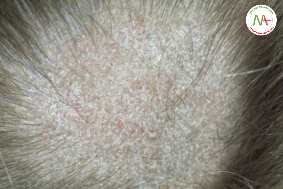 HÌNH 20.6 Nấm da đầu - mảng rụng tóc hình tròn có vảy với những sợi tóc kiểu “chấm đen” điển hình do các sợi tóc yếu bị gãy do nấm xâm nhập.