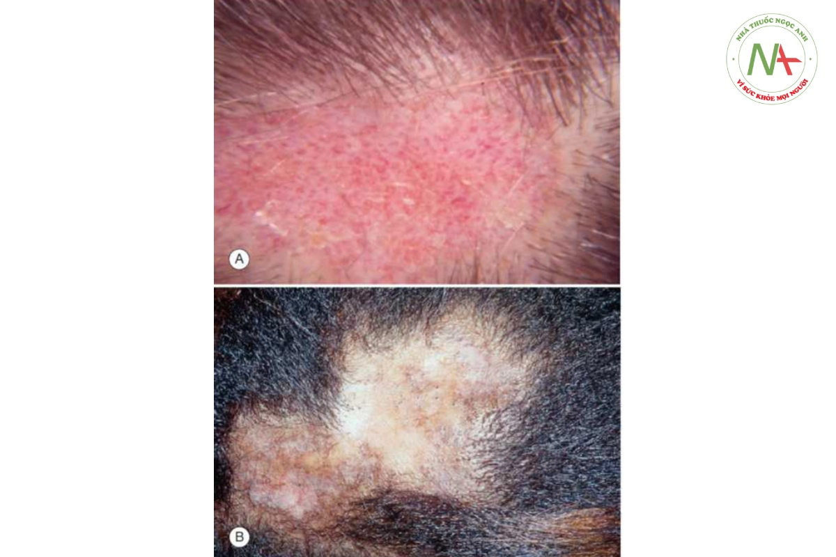 HÌNH 20.8 Lupus ban đỏ dạng đĩa. A. Tổn thương sớm có ban đỏ và sẹo. B. Tổn thương muộn biểu hiện tăng sắc tố và giảm sắc tố trong rụng tóc có sẹo ở vùng da sẫm màu.
