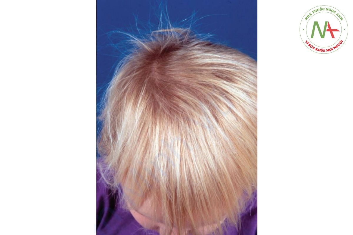 HÌNH 20.24 Hội chứng anagen lỏng lẻo - một bé gái 2 tuổi với kiểu hình cổ điển là tóc vàng ngắn không mọc; trong trường hợp này, tóc mỏng lan tỏa.