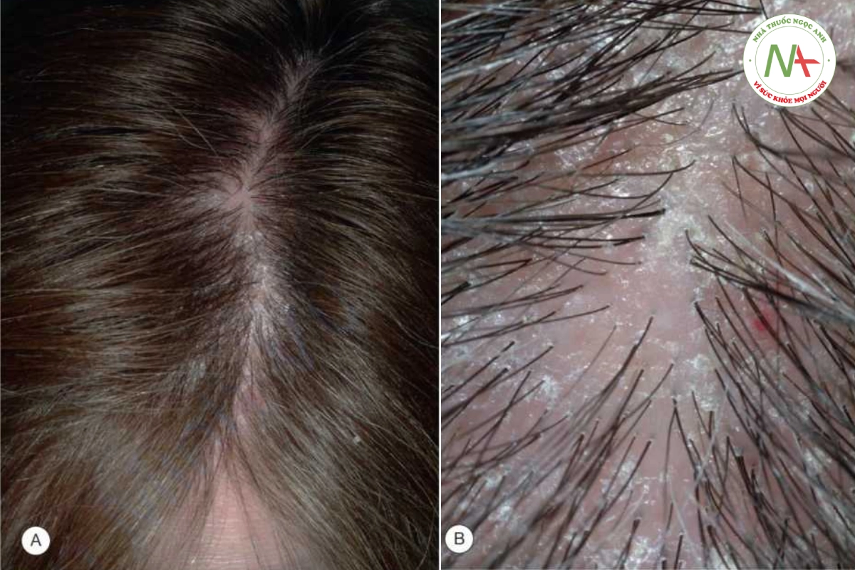 HÌNH 20.9 Lichen planopilaris. A. Lưu ý tóc mảnh trên đỉnh đầu; chẩn đoán ban đầu là rụng tóc kiểu nữ. B. Kiểm tra kỹ cho thấy rụng tóc vĩnh viễn (ví dụ: mất nang lông) và đỏ và có vảy quanh nang lông.