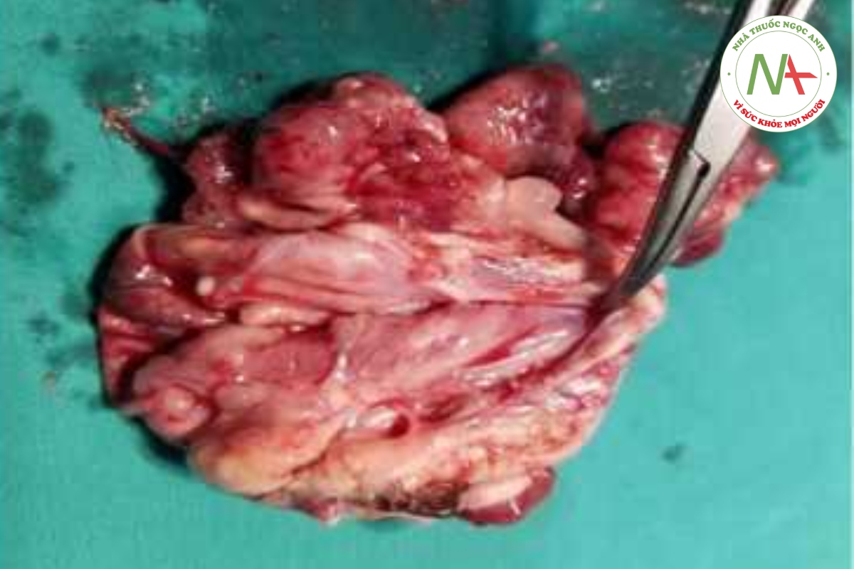 Hình 4. hình ảnh u buồng trứng sau phẫu thuật (Người bệnh số 2)