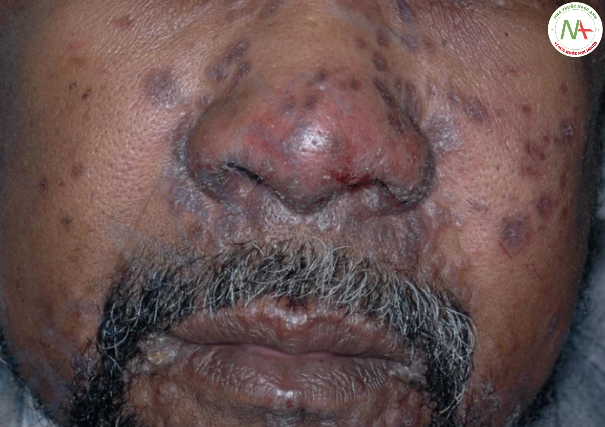 Hình 21 Sarcoidosis –các mảng chai cứng màu nâu đỏ trên mặt, vị trí phổ biến