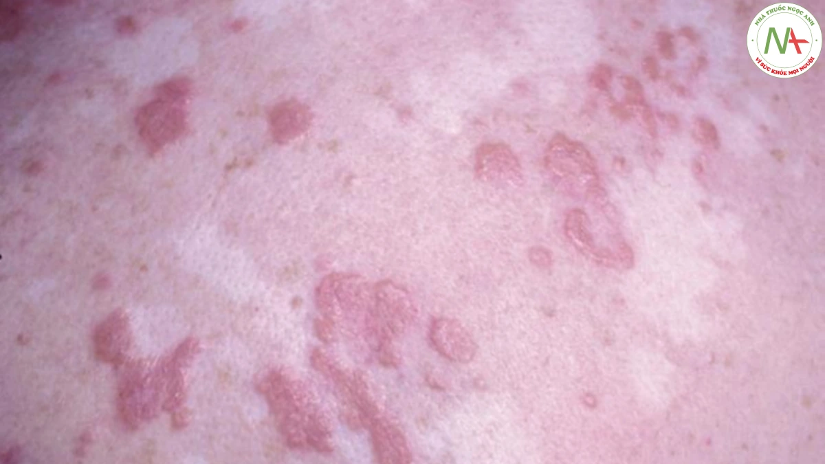 Hình 4 Bệnh sarcoidosis ở da – mảng dạng vòng, màu nâu đỏ