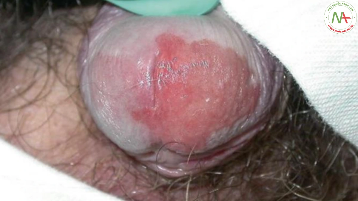 Hình 8 Lichen xơ hoá sinh dục có trợt – mảng bị trợt trên quy đầu dương vật; sinh thiết được thực hiện để loại trừ ung thư biểu mô tế bào vảy