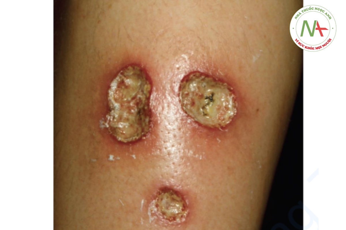HÌNH 19.2 Viêm mạch - nhiều vết loét hình thành trên chân của một bệnh nhân bị viêm khớp dạng thấp.