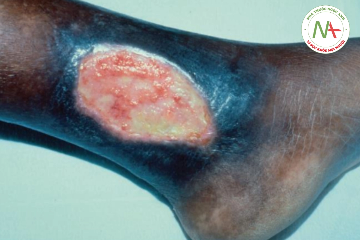 HÌNH 19.4 Thiếu máu hồng cầu hình liềm - vết loét ở cẳng chân ở một bệnh nhân da đen.