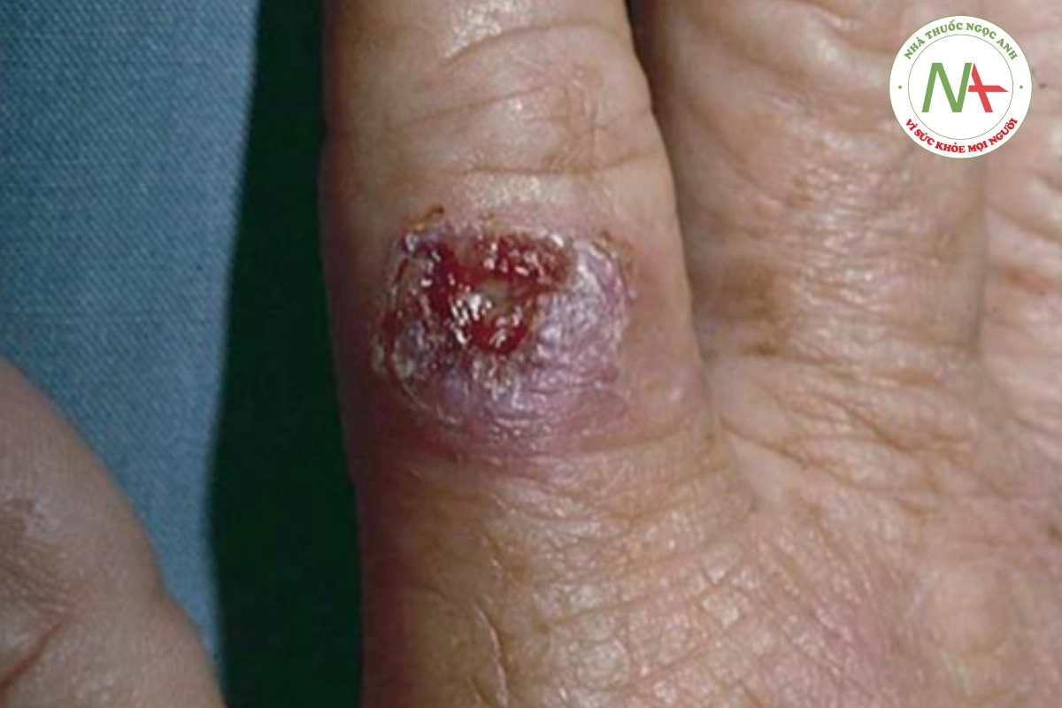 HÌNH 19.6 Sporotrichosis - loét ngón tay phát triển sau chấn thương khi làm vườn.