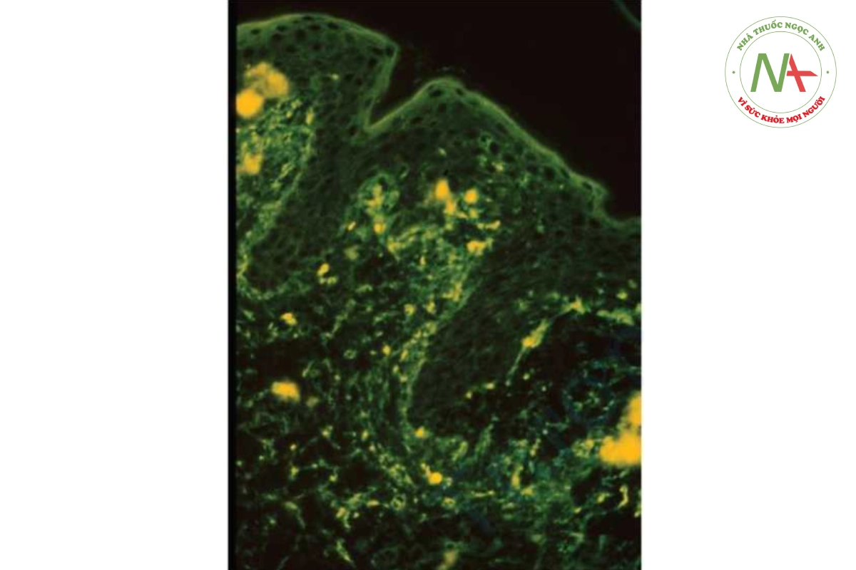 HÌNH 10.11 Viêm da herpetiformis - nhuộm miễn dịch huỳnh quang trực tiếp và gián tiếp cho thấy lắng đọng dạng hạt của globulin miễn dịch A ở đầu các nhú bì.