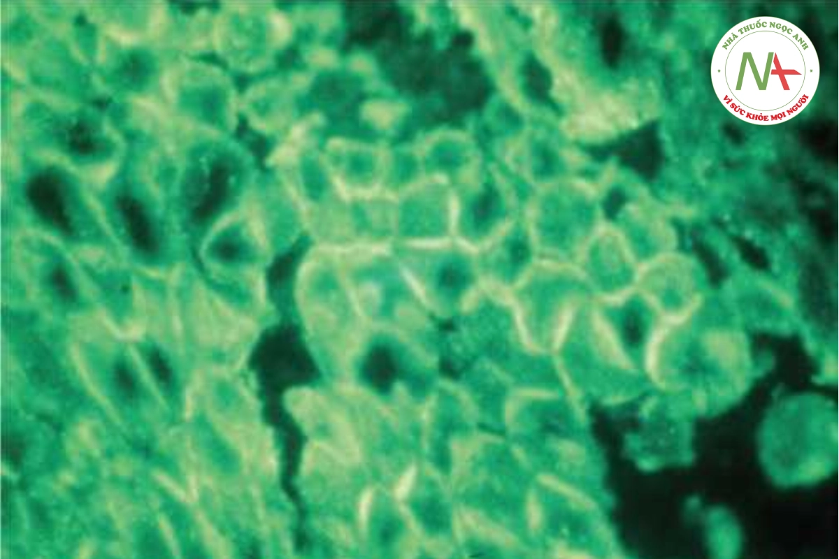 HÌNH 10.15 Pemphigus vulgaris - nhuộm miễn dịch huỳnh quang trực tiếp và gián tiếp cho thấy vết nhuộm gian bào với IgG và bổ thể.