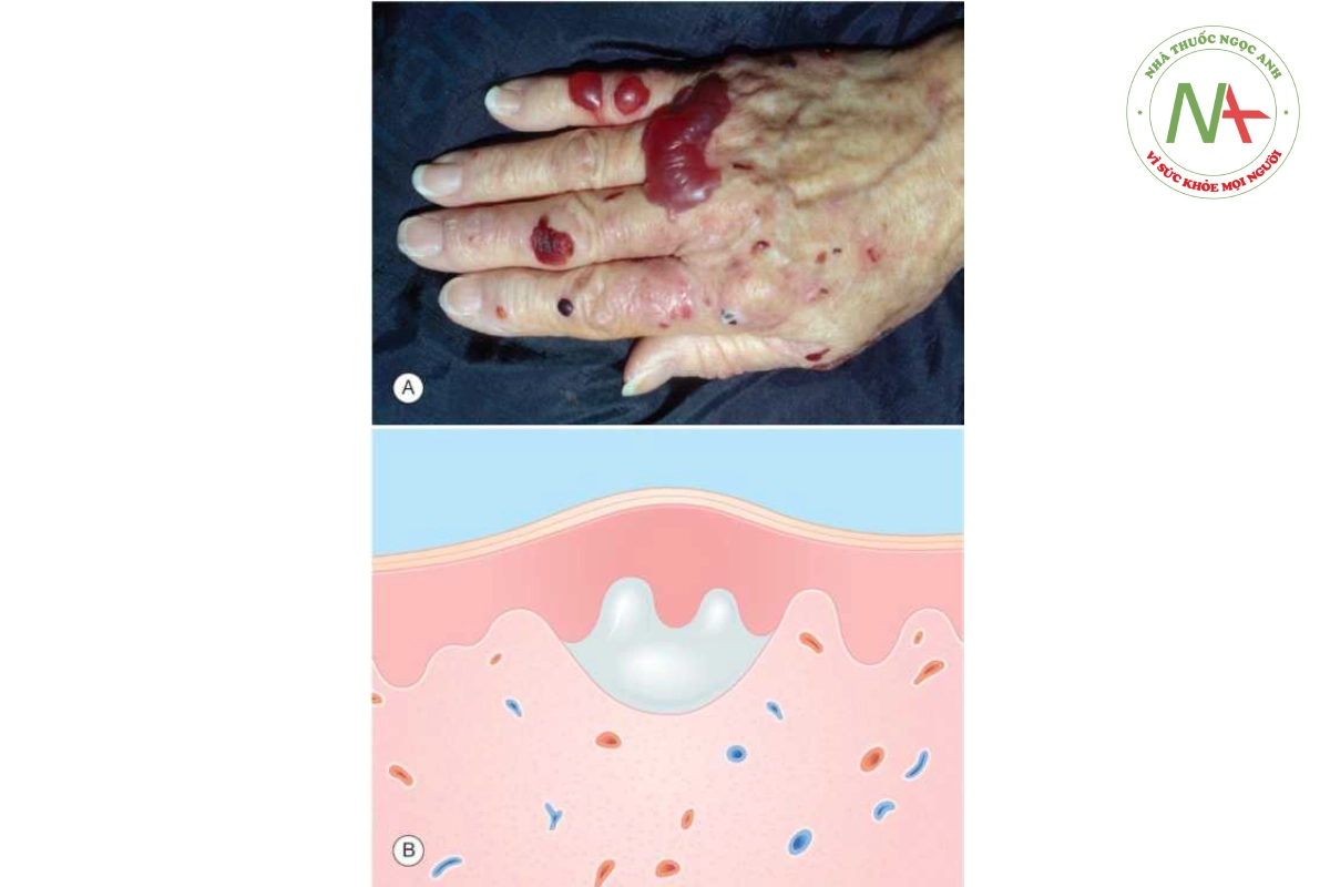 HÌNH 10.16 Porphyria cutanea tarda. A. Bóng nước xuất huyết căng ở mu bàn tay, vị trí điển hình. B. Lớp bì - bọng nước dưới biểu bì.