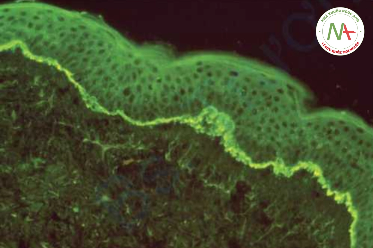 HÌNH 10.9 Pemphigoid bóng nước - nhuộm miễn dịch huỳnh quang trực tiếp và gián tiếp cho thấy sự lắng đọng tuyến tính của globulin miễn dịch G hoặc bổ thể tại vùng nối bì-biểu bì.