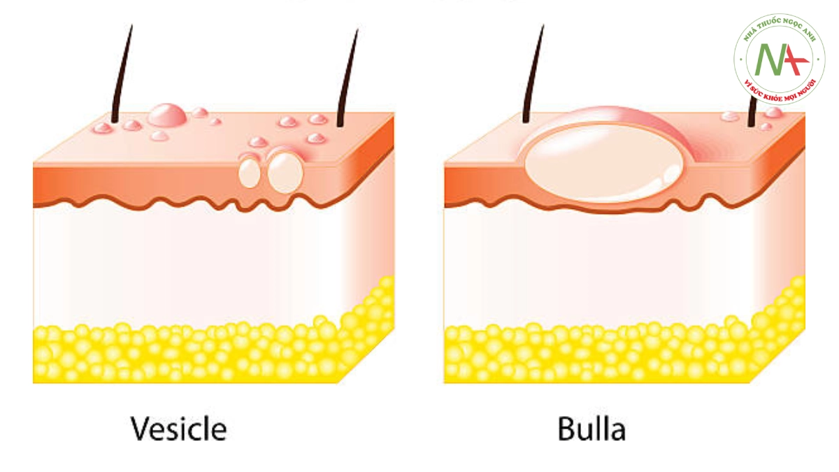 Mụn nước và bóng nước (Vesicles and bullae)