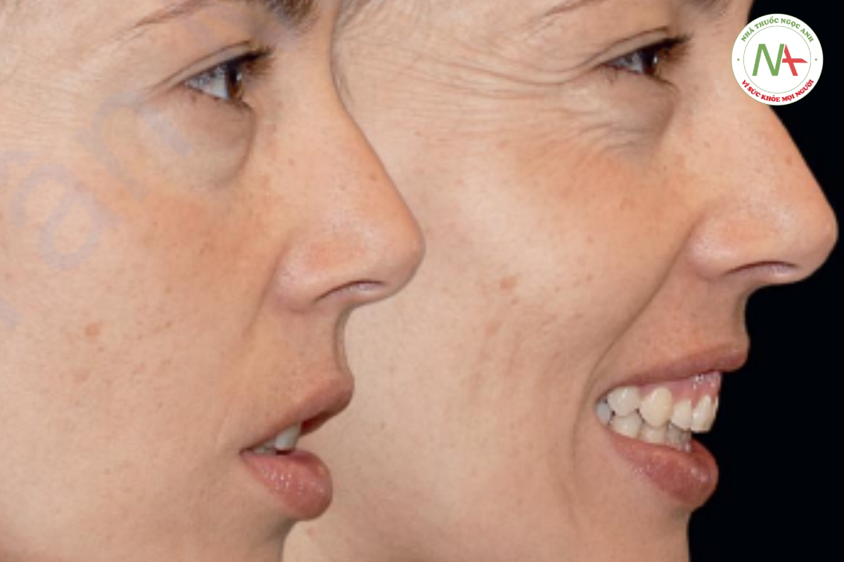 Hình 1-13 (a và b) Các nếp nhăn tĩnh được hình thành trong quá trình biểu cảm trên khuôn mặt và không mờ đi khi kết thúc hoạt động của cơ. Khi nghỉ ngơi, chúng đáng chú ý. Sự hiện diện của nếp nhăn cho thấy gương mặt bệnh nhân này đang trong quá trình lão hóa.